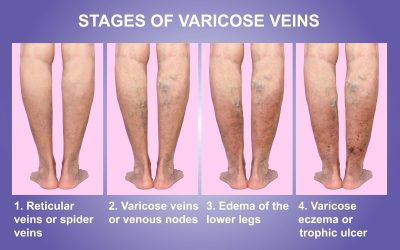 Eliminating Varicose Veins by Undergoing Outpatient Sclerotherapy